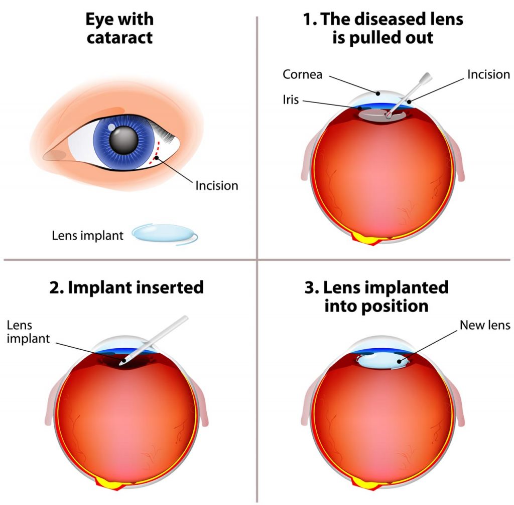 cataract-surgery-how-it-can-improve-your-vision-and-your-life