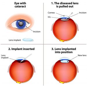 West Side Eye Clinic Cataract Eye Surgery