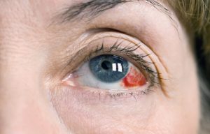 Eye Injuries in Sports - Medical Associates of Northwest Arkansas